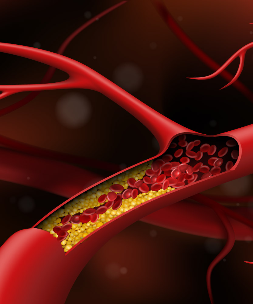 Elementos vinculados a ASCVD